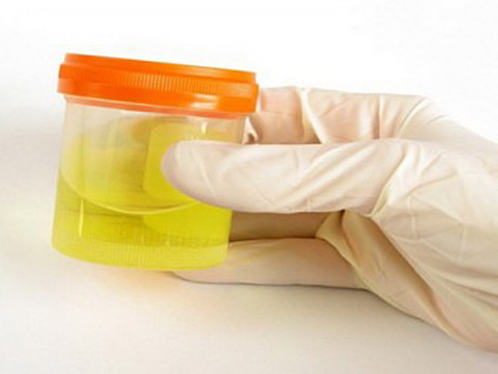 Білок у сечі